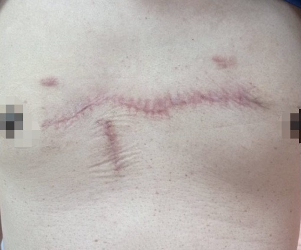 擠破青春痘 增生成10多公分蟹足腫