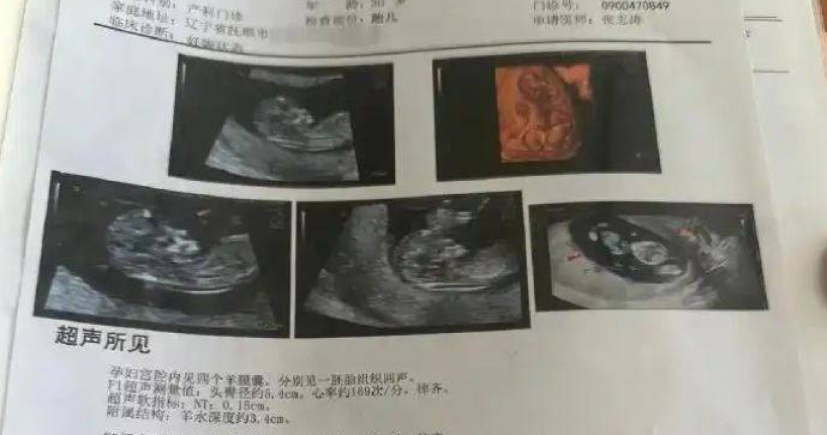 產檢1次多1胎！30歲孕婦懷「同卵四胞胎」　醫驚：機率僅1500萬分之1