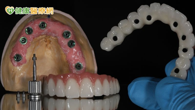 全口重建進入「精準導航」時代！「四支植體結合AI」撐起一口好牙