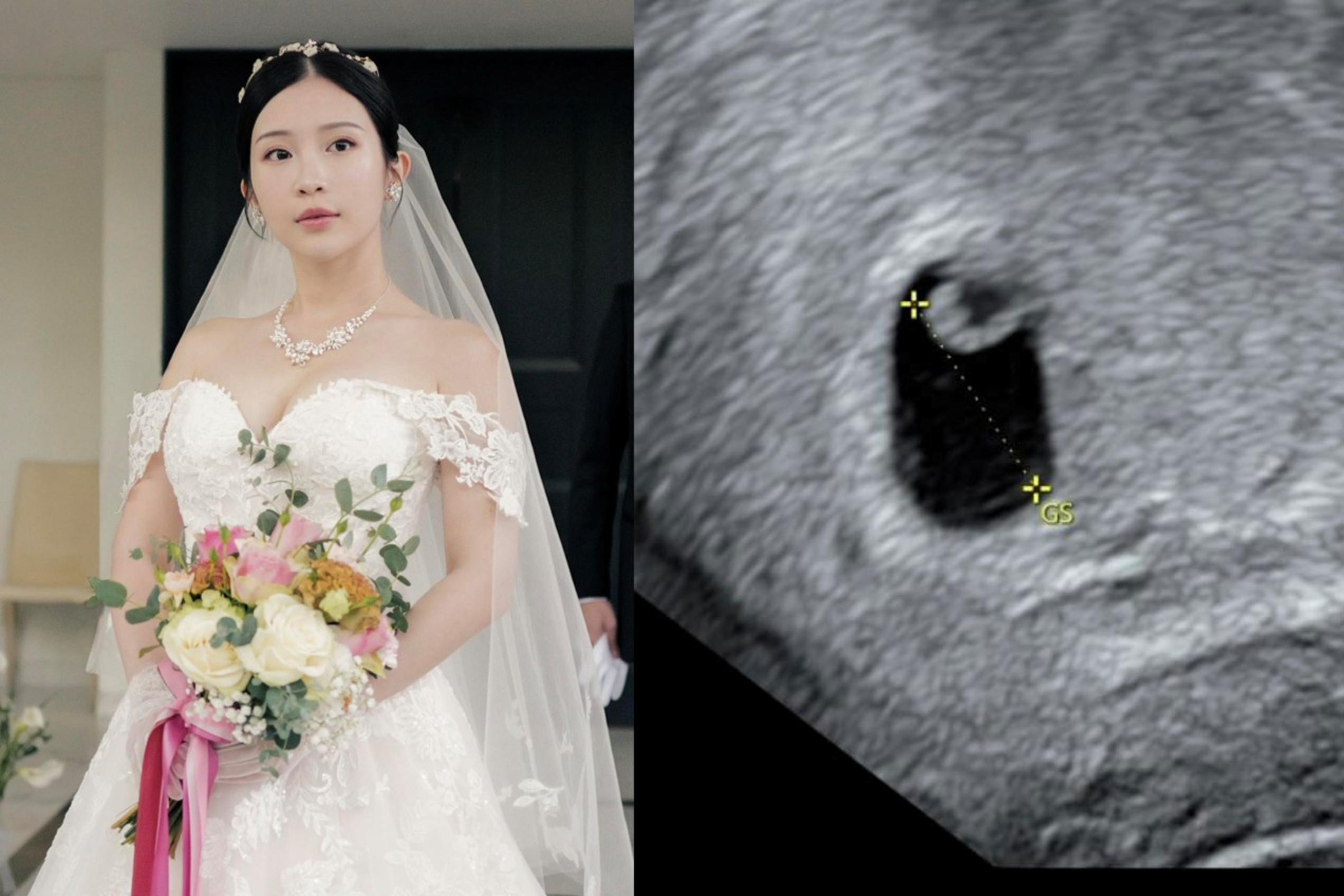 雞排妹鄭家純懷孕9週流產　中醫解析初期流產身心影響：修復不只在子宮