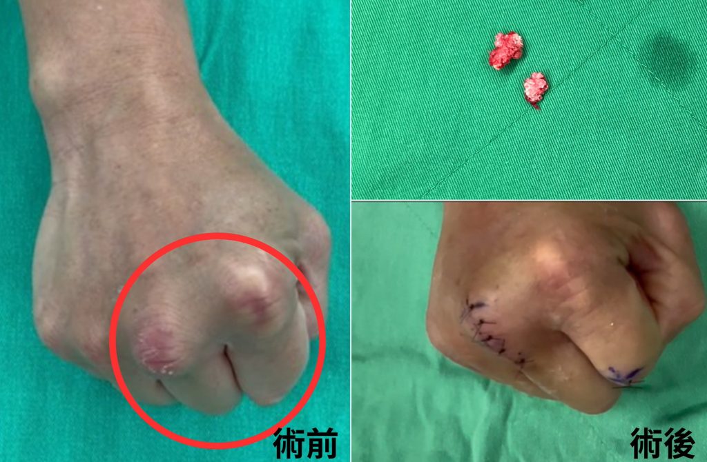 竹科男手指卡關 微創超音波刀切除痛風石解困