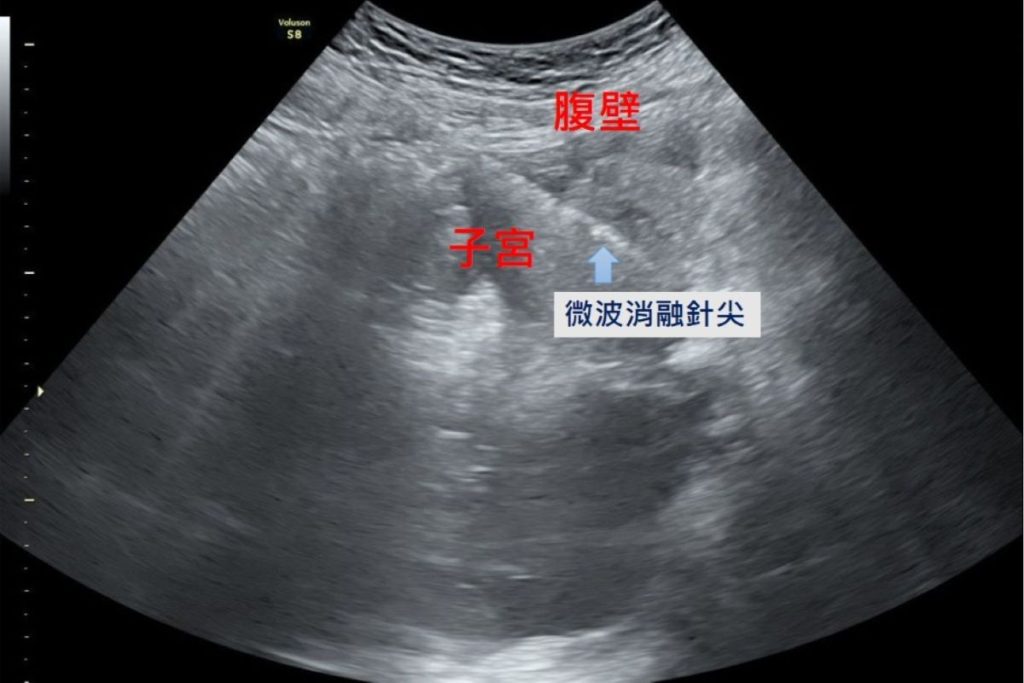 女經痛難耐 原是子宮肌腺瘤作祟